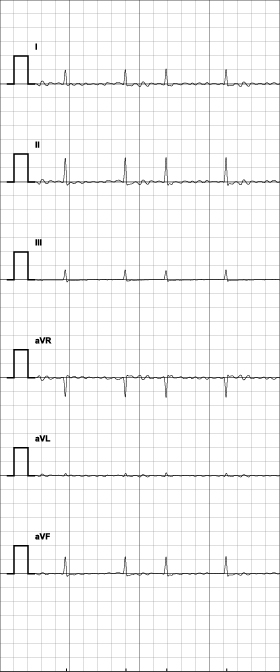 6誘導心電図イメージ